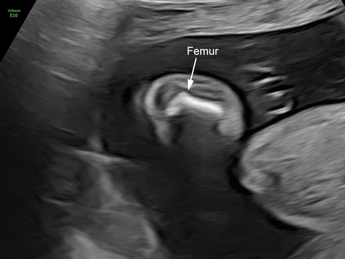 20w gestation: severe micromelia with bowing and angulation of the femur.