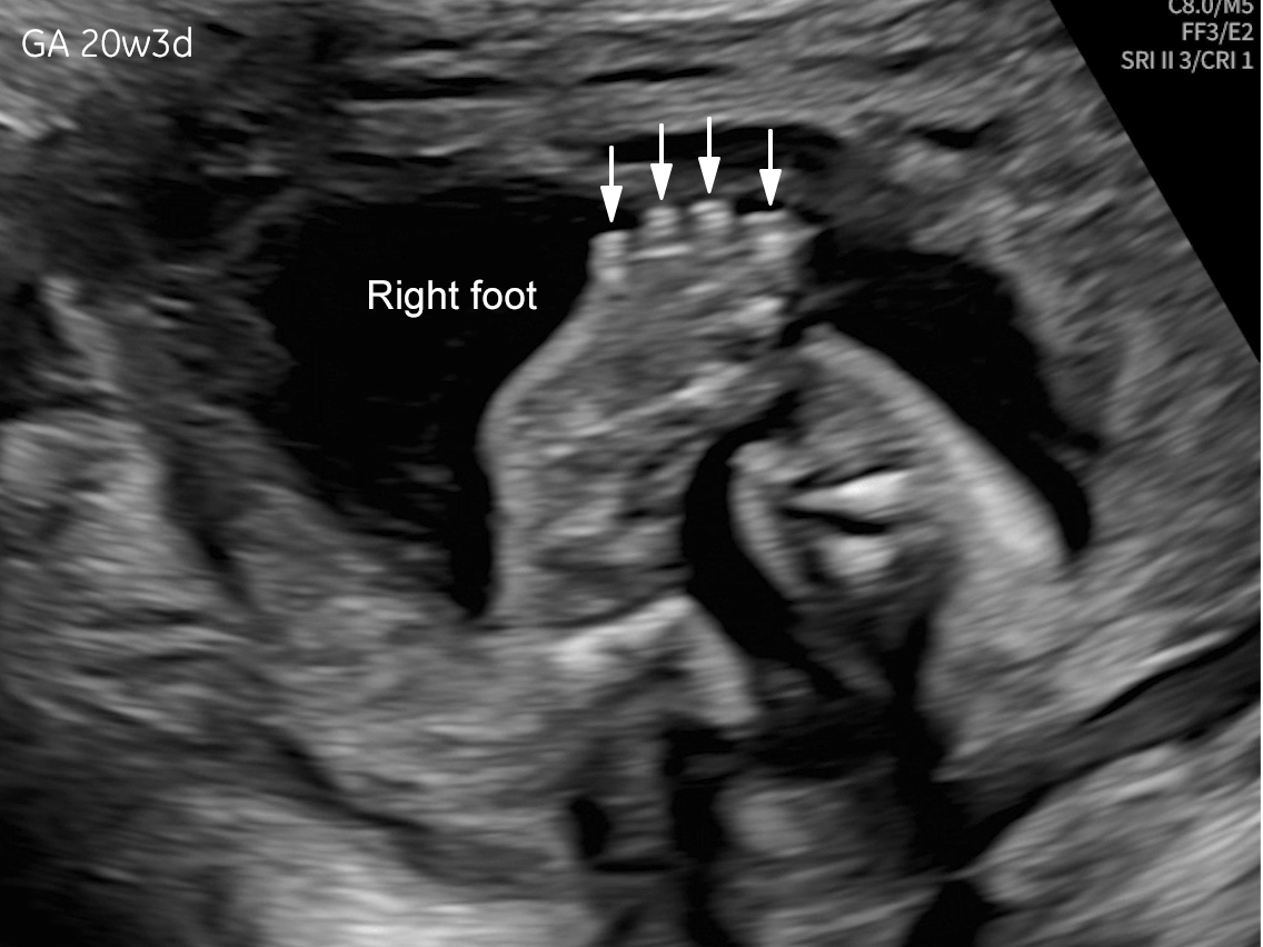 20w gestation: right foot oligodactyly (only four digits visible, arrows).