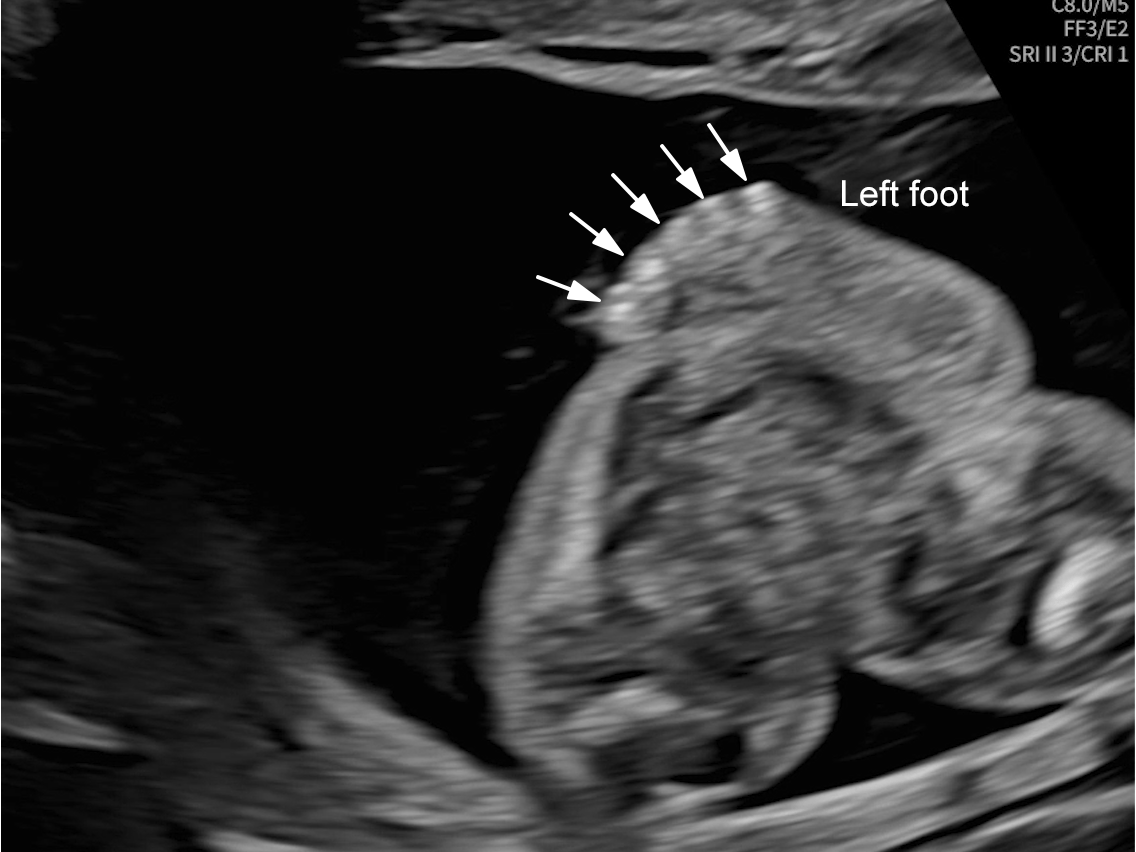 20w gestation: left foot with a normal number of digits (arrows).