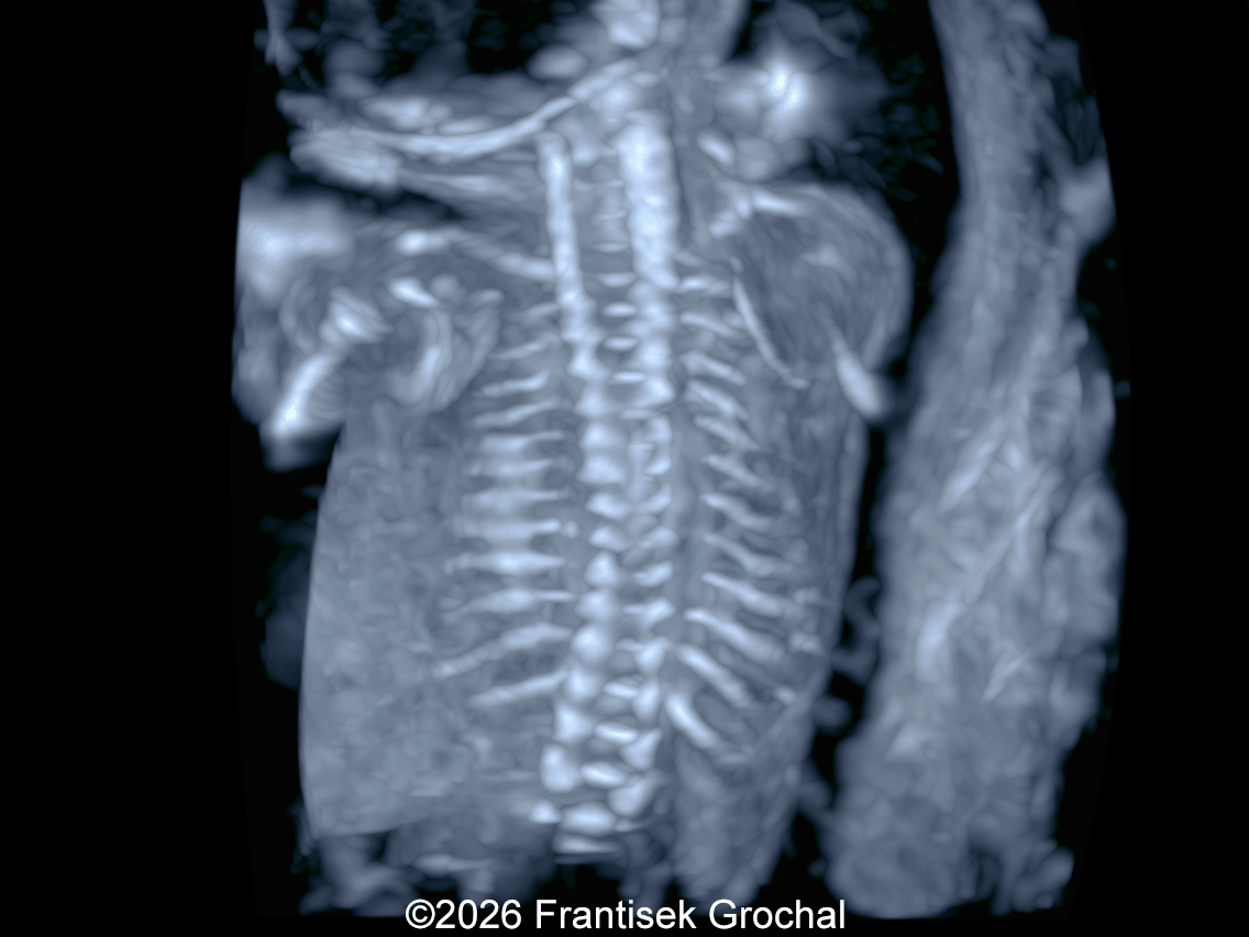 20w gestation: 3D imaging of the fetal spine and ribs showing mild scoliosis, normal scapulae, normal spinal ossification, and no rib fractures.