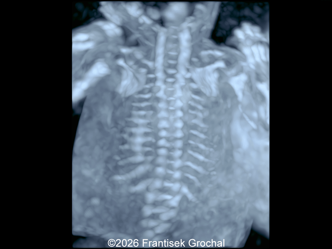 20w gestation: 3D imaging of the fetal spine and ribs showing mild scoliosis, normal scapulae, normal spinal ossification, and no rib fractures.