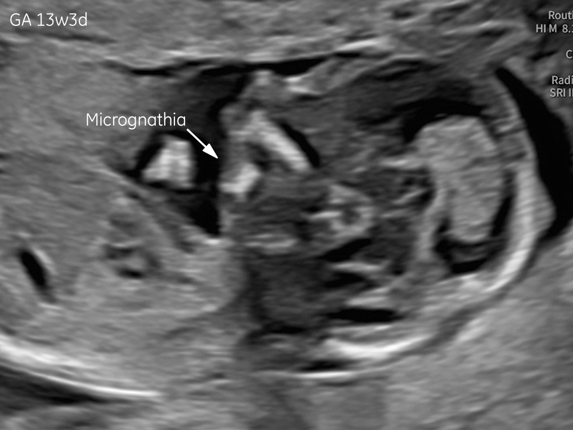 13w gestation: micrognathia (arrow).