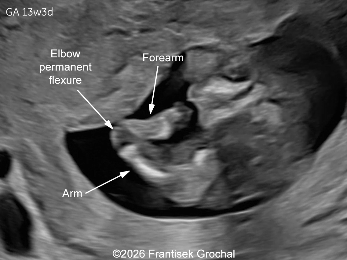 At 13w gestation, fixed flexion contracture of the elbow is visible.