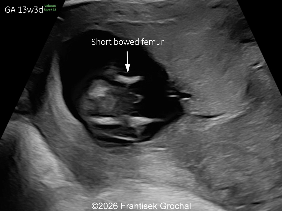 13w gestation: severe micromelia with femoral bowing and angulation.