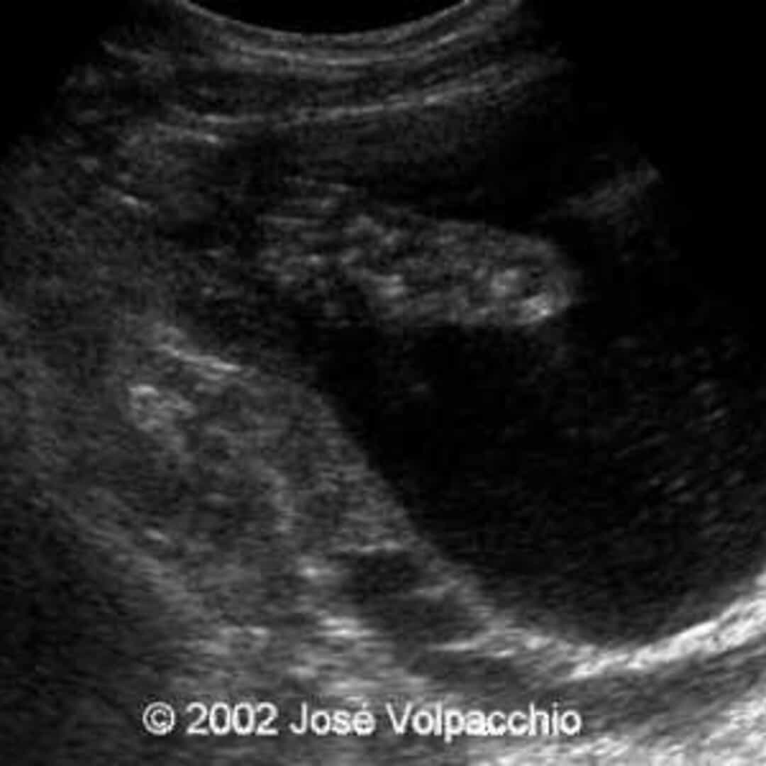 📃 Talipes, unilateral