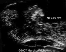 Pulmonary atresia, intact ventricular septum, right ventricle to right coronary artery fistula and secondary tricuspid dysplasia image