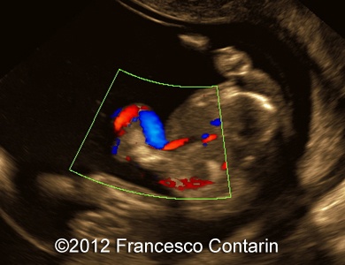 Omphalocele