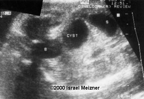 ������ Ovarian cysts