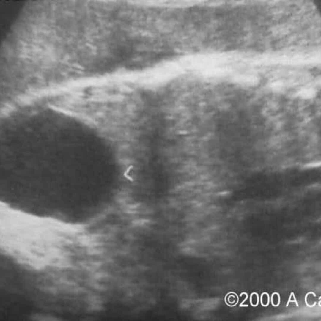 📃 Ovarian cyst, torsion