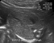 Right aortic arch, isolated cleft lip image