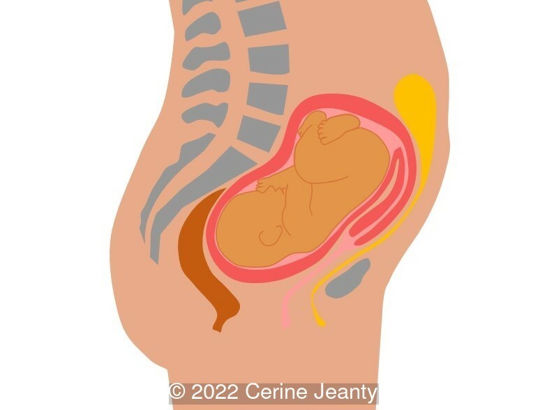 Figure 1 from Acute Urinary Retention Due to an Incarcerated Retroverted  Gravid Uterus