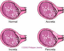 Placenta percreta image