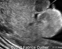 Endometrial polyps in early pregnancy image