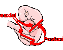 Post axial acrofacial dysostosis image