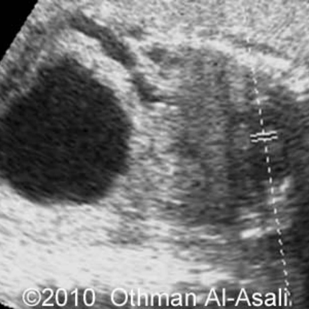 📃 Posterior urethral valve syndrome