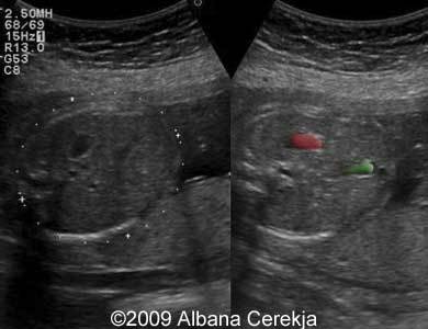 umbilical vein ultrasound