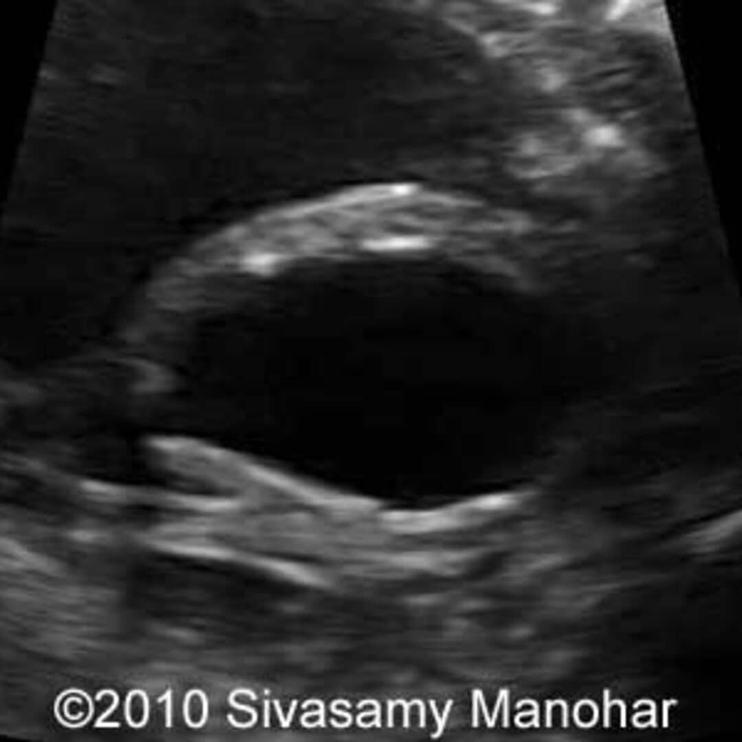 📃 Posterior urethral valve with bladder rupture and urinary ascites