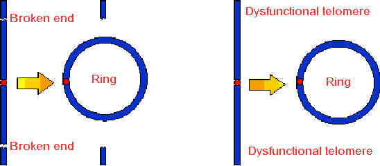  Ring Chromosome 14