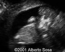 Acrania from amniotic bands image