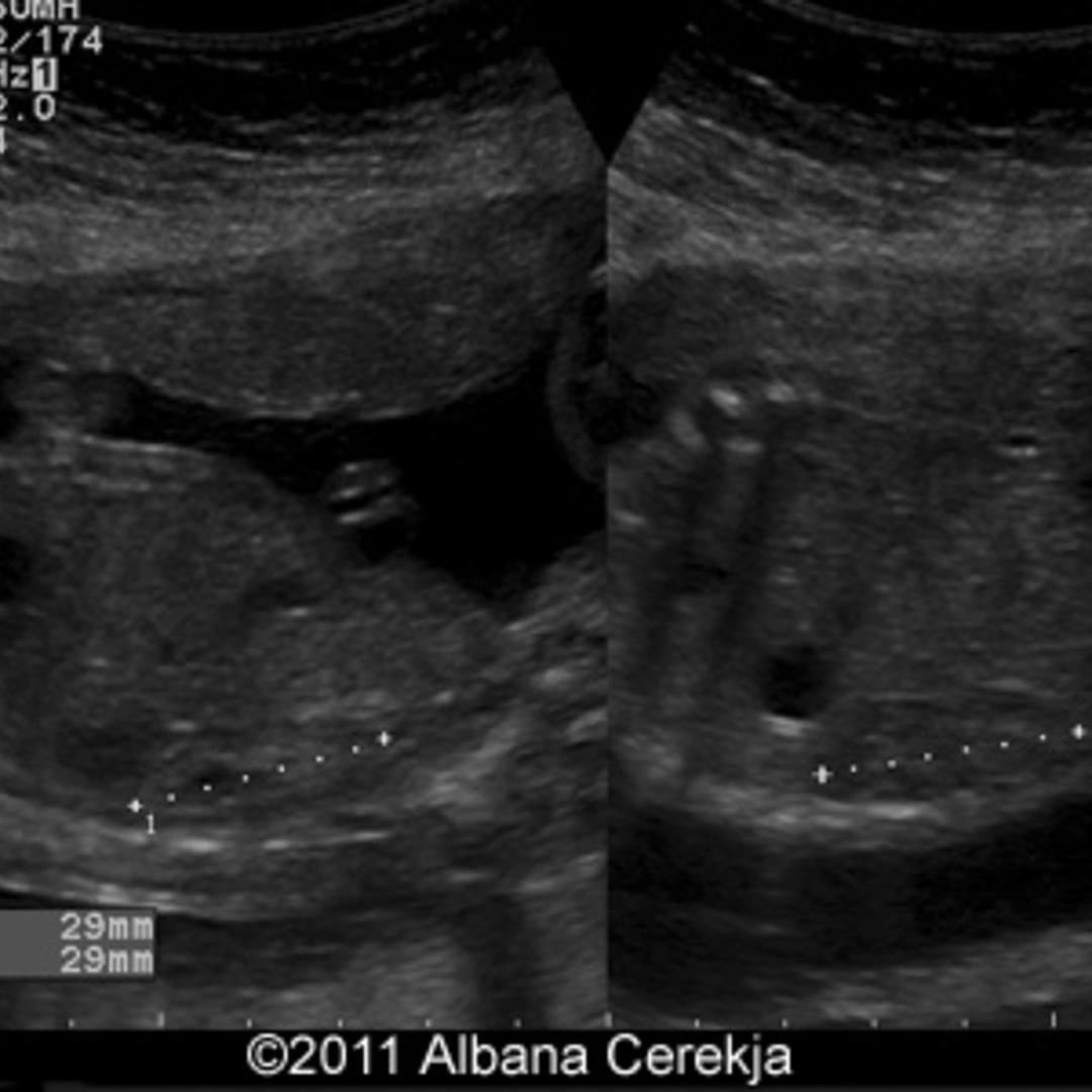 Duplex Kidney duplex-kidney
