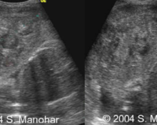 Abruptio placenta image