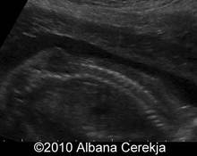 Spina bifida with myelomeningocele image