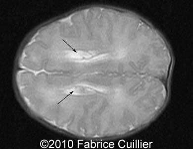 Subependym_cyst_Fabrice15a