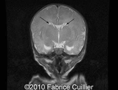 Subependym_cyst_Fabrice16b