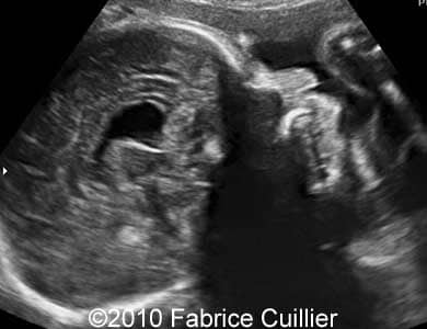 Subependymal_cyst_Fabrice_1
