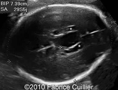 Subependymal_cyst_Fabrice_2