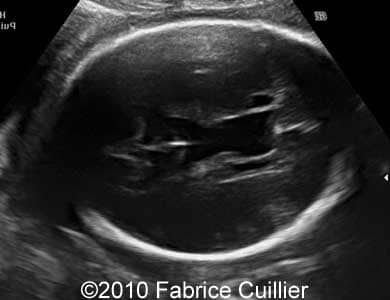 Subependymal_cyst_Fabrice_3