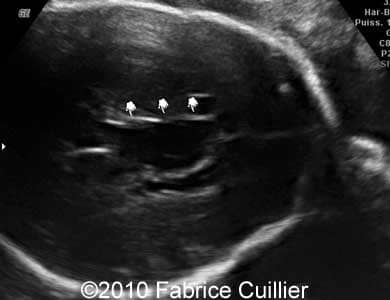 Subependymal_cyst_Fabrice_4