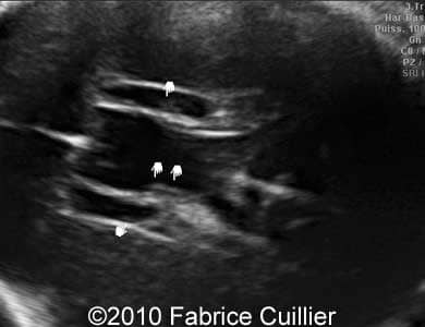 Subependymal_cyst_Fabrice_5