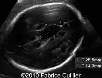 Subependymal_cyst_Fabrice_6