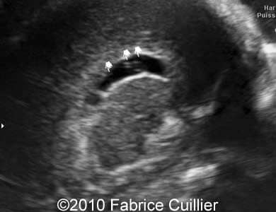 Subependymal_cyst_Fabrice_7