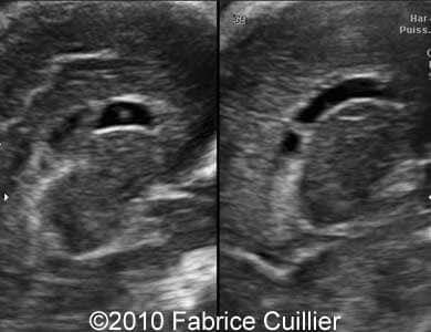 Subependymal_cyst_Fabrice_8