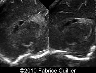 Subependymal_cyst_Fabrice_9