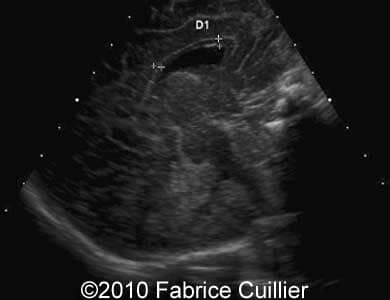 Subependymal_cyst_Fabrice11