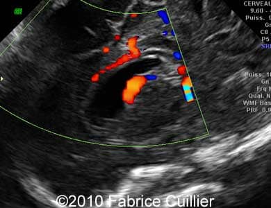 Subependymal_cyst_Fabrice12