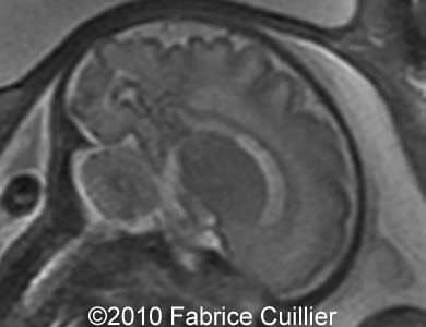 Subependymal_cyst_Fabrice13