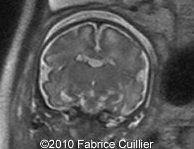 Subependymal_cyst_Fabrice14