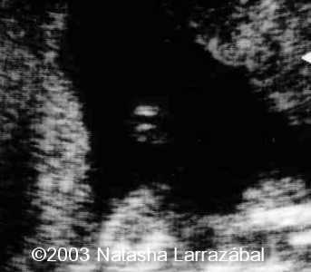 T18 The fetus 13