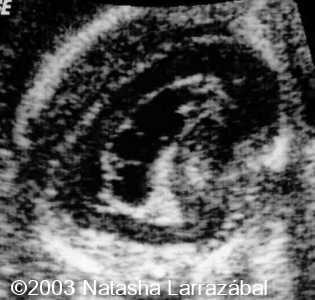 T18 the fetus 3
