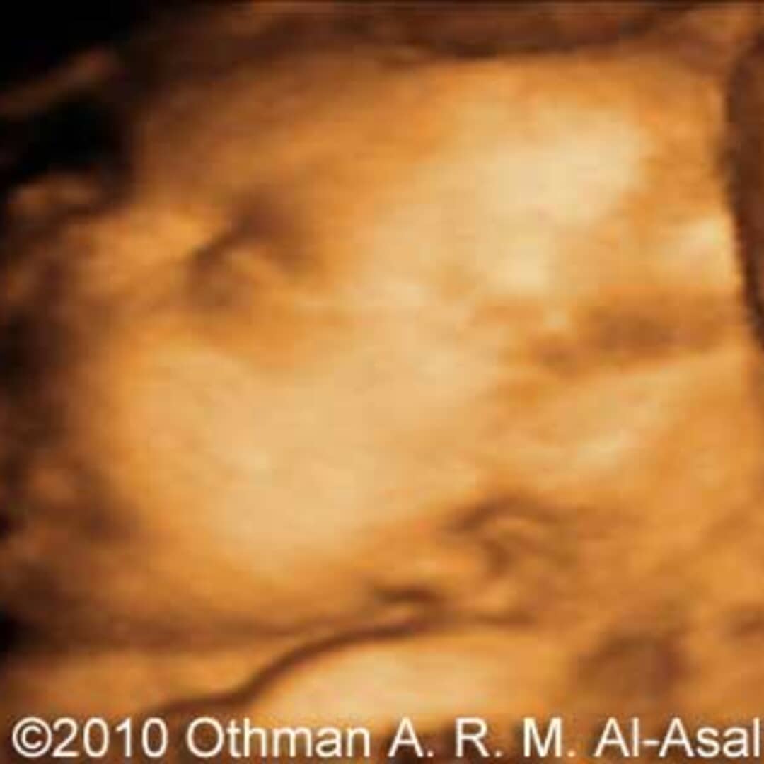 Ecografia 3d 20 settimane