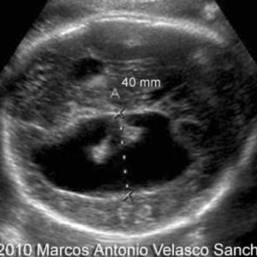 Modifying Risk for Aneuploidy with Second-Trimester Ultrasound After a  Positive Serum Screen
