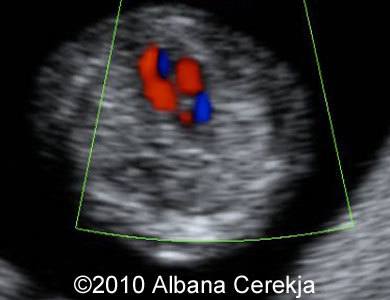 Trisomy13_Albana_1