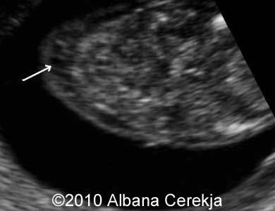 Trisomy13_Albana_10