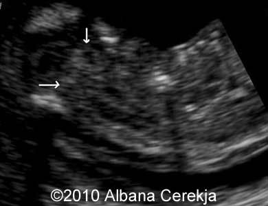 Trisomy13_Albana_11