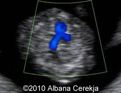 Trisomy13_Albana_12