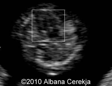 Trisomy13_Albana_13
